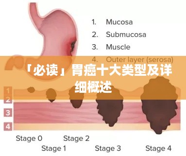 「必读」胃癌十大类型及详细概述